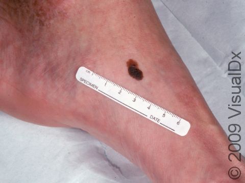This image displays a darkly pigmented lesion typical of melanoma.