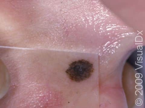 This image displays an almost black melanoma found in between the toes.