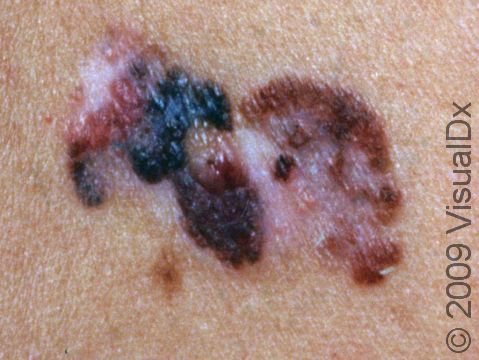 This melanoma has multiple dark colors, an asymmetrical shape, and a very irregular border typical of melanoma.