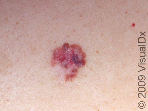 This image displays a lesion with an irregular edge and multiple colors--white, pink, pink-brown, and flecks of blue-black--typical of melanoma.