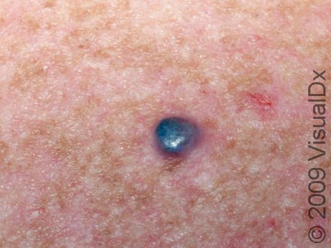 This melanoma has a classic blue-black color.