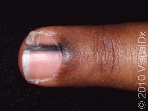 When a melanoma involves the fingernail, the cuticle often has the discoloration as well as the nail plate.