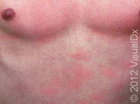 Miliaria rubra can appear as blotches of red or pink skin.
