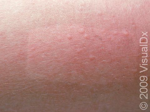 The papules (small, solid bumps) of miliaria rubra often appear within red or pink areas of skin.