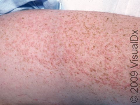 In miliaria rubra, the papules (small, solid bumps) are usually all approximately the same size and concentrated in the same skin area.