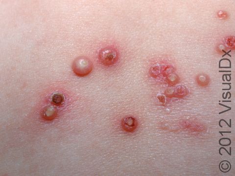 Small, dome-shaped, solid bumps, often with a small depression, are typical of molluscum.