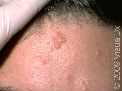 Molluscum contagiosum is caused by a common poxvirus. Associated with the virus, firm, skin-colored, pus-filled lesions with a central depression are typically present.