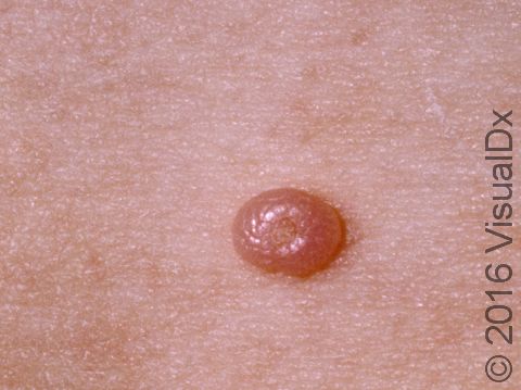 Molluscum contagiosum is a benign, poxvirus infection that typically has a central depression.