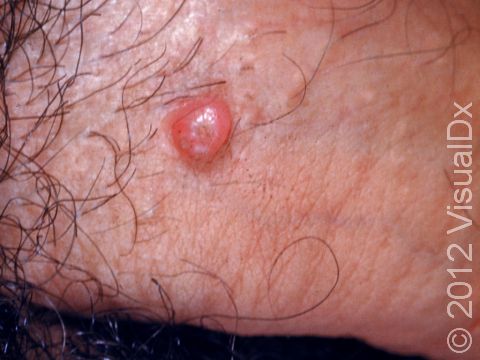 Molluscum Contagiosum Condition Treatments and Pictures for Teens