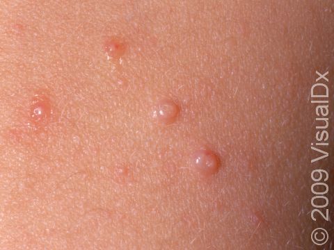 This close-up image displays smooth, skin-colored bumps with a slight depression at the center, typical of molluscum.