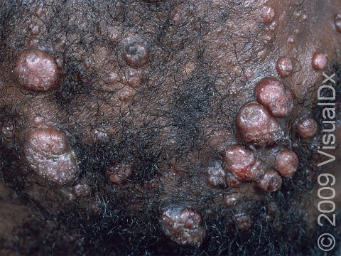 This image displays multiple large molluscum lesions on an immunocompromised patient.
