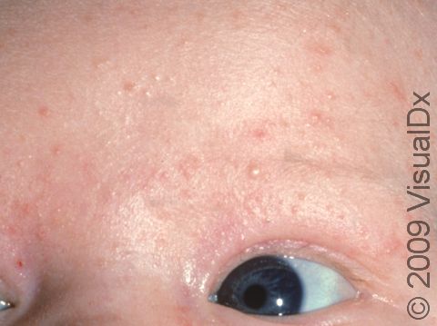 In neonatal acne, there can be redness as well as whiteheads.