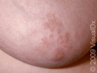 Nipple Dermatitis – Adult
