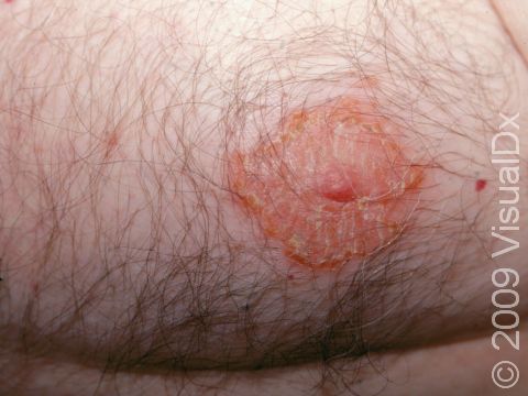 This image displays dermatitis affecting the nipple of a man.