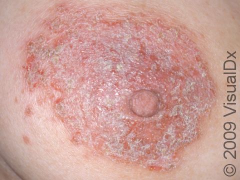 This image displays a severe case of nipple dermatitis.