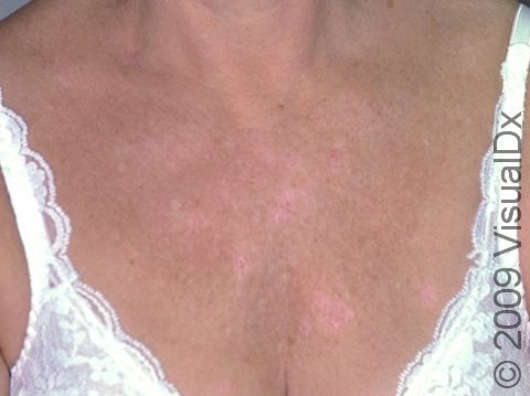 There are subtle, light pink, round, scaling patches of nummular dermatitis on this woman's chest.