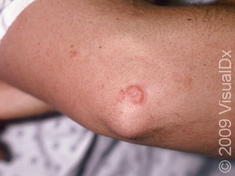 This image displays a round, pink, scaly, slightly elevated lesion typical of nummular dermatitis.