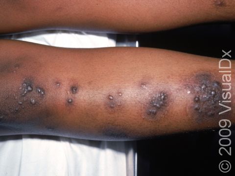 This image displays a severe case of nummular dermatitis.