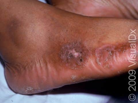 This image displays the round circles typical of nummular dermatitis.