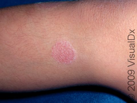 This image displays a pink, scaly, round, slightly elevated lesion typical of nummular dermatitis.