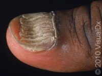 Nail Infection, Fungal (Onychomycosis)
