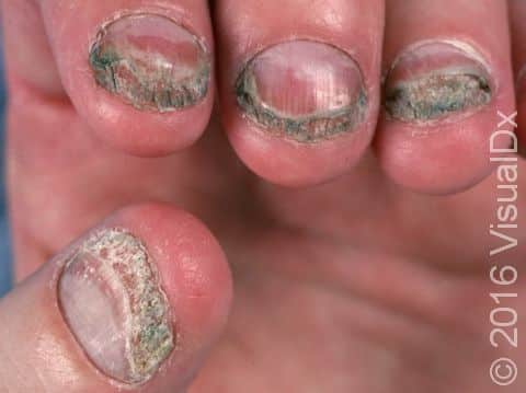 This image displays nails that have broken and not regrown to normal length, typical of onychomycosis.