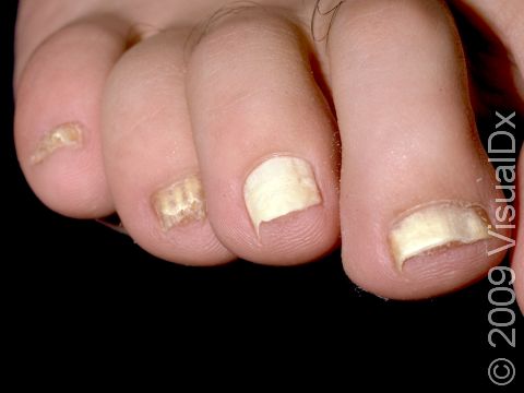 In some cases, nails can turn white as a result of onychomycosis (nail fungus infection).