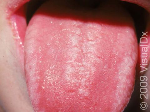 Oral candidiasis (thrush) frequently has a white patch at the middle of the tongue, as displayed in this image.