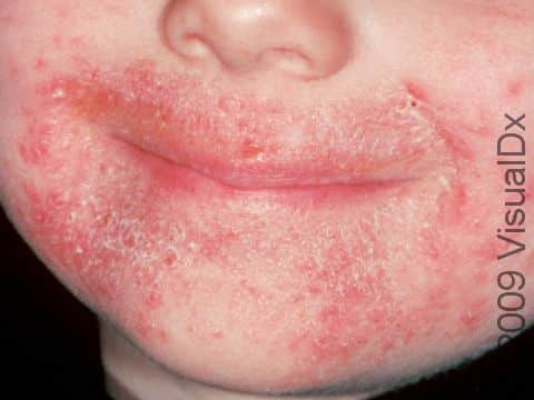 This image displays an extensive yeast (candida) infection around the mouth, with tiny red bumps and pus-filled lesions.