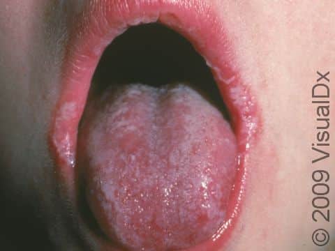 This image displays white areas on the lips and tongue typical of candidiasis, an oral yeast infection, also known as thrush.