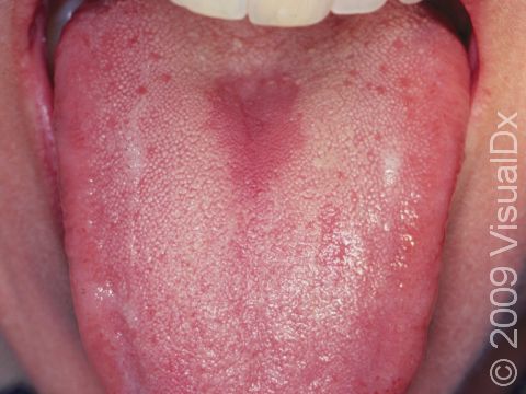 Candida (yeast) infection of the mouth, also known as thrush, can cause a smooth patch at the middle of the tongue, as displayed in this image.