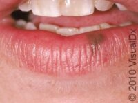 Oral Melanotic Macule – Adult