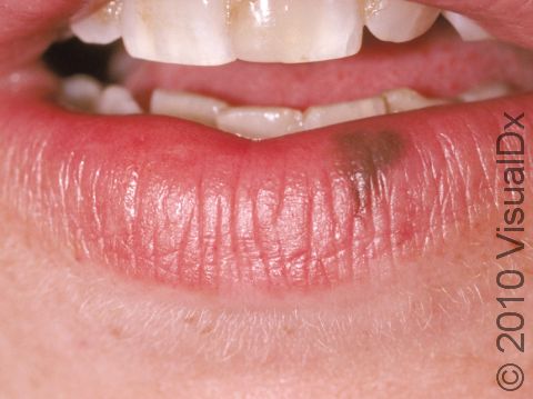 This image displays a typical brown oral melanotic macule, a flat, small lesion.