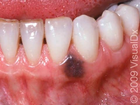 This image displays an oral melanotic macule on the gums.