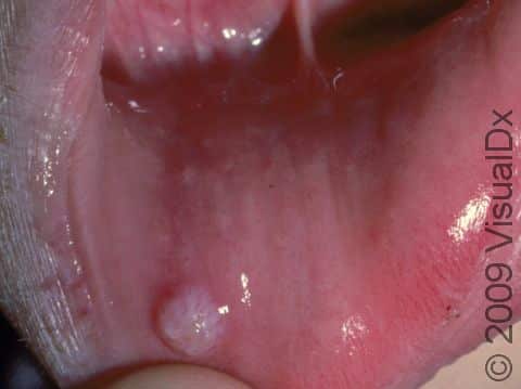 This image displays a mucocele inside the lip.
