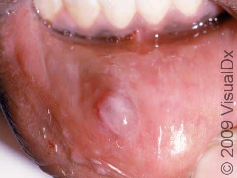 This image displays a close-up of a mucocele.