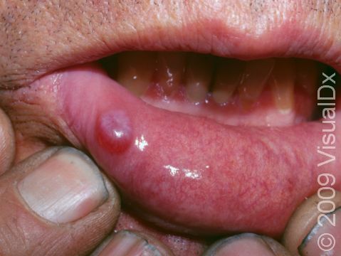This image displays a bluish oral mucocele on the lower lip.