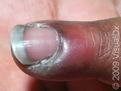 This image displays redness and swelling around the cuticle of the nail typical of early paronychia.