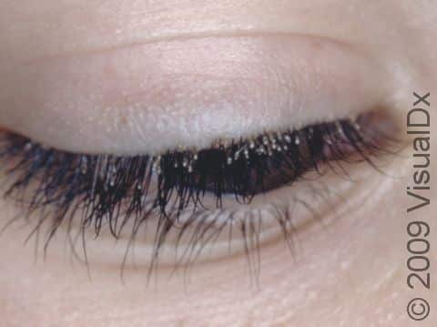 Tiny white head lice eggs (nits) can been seen, glued to the base of this childs eyelashes.