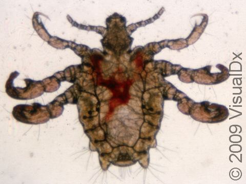 This image displays pediculosis pubis (pubic lice, crab lice).