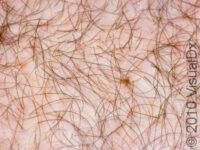 Pubic Lice (Pediculosis Pubis) – Adult