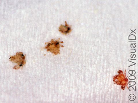 Pubic lice are easily seen and give a speckled, dirty appearance to a heavily infested area.