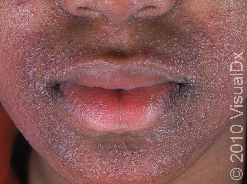 Stress Rash On Face Around Mouth - Infoupdate.org