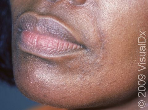 This image displays small pink-brown bumps and pus-filled lesions around the mouth typical of dermatitis.