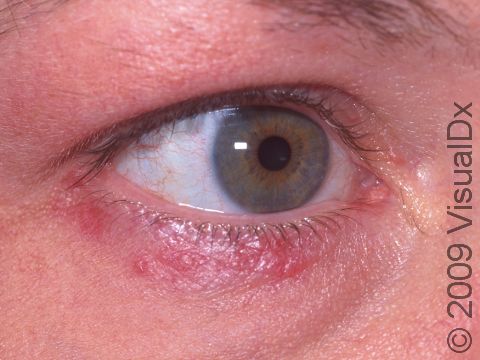 This image displays an affected eye region typical to perioral dermatitis.