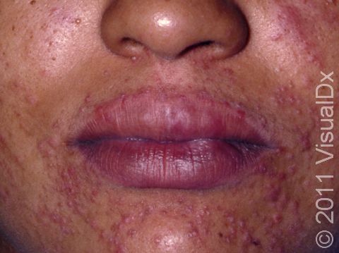In perioral (around the mouth) dermatitis, bumps can extend onto the cheeks.