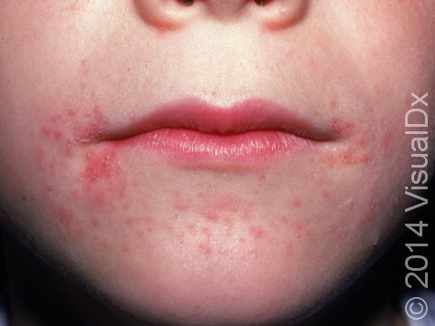 This image displays acne-like red bumps around the mouth typical of perioral dermatitis.