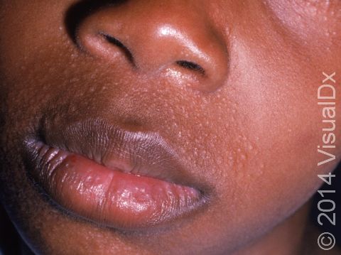 Tiny bumps and pus-filled lesions around the mouth are typical of perioral dermatitis.