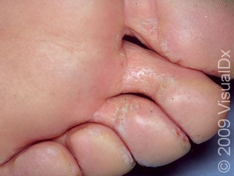 This image displays numerous pits that are often associated with increased sweating and foot moisture.