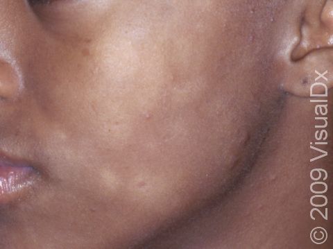 Pityriasis alba can cause light patches of skin, typically involving the face, in people with darker skin.